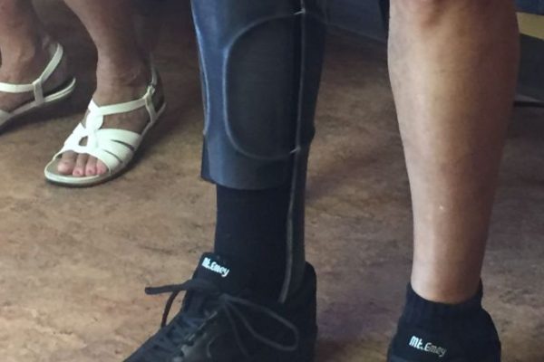 Why Carbon Fiber Braces Are Revolutionizing Orthotics