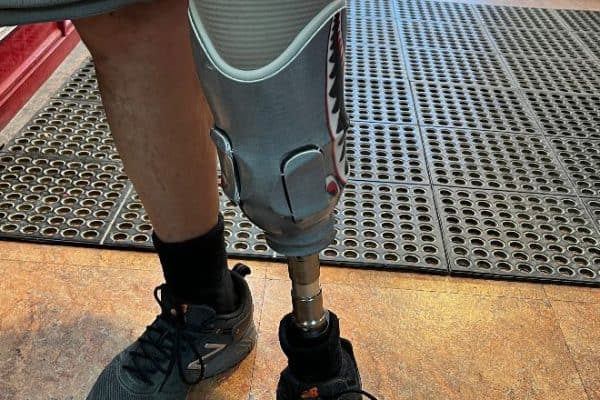 Someone Showing Off Their Prosthetic Leg