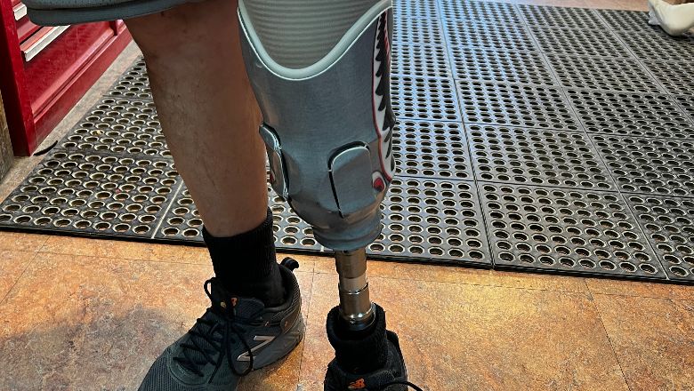 Someone Showing Off Their Prosthetic Leg