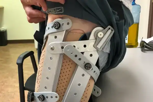 A Close-Up Of A Prosthetic On A Person&Amp;Apos;S Leg.